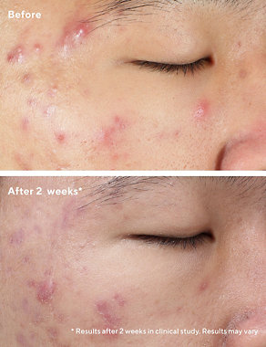 Deep Relief Blemish Treatment 30ml Image 2 of 5